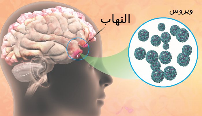 بیماری آنسفالیت مغزی چیست