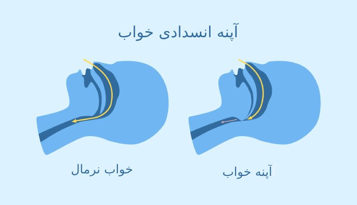 عوارض و خطرات آپنه خواب