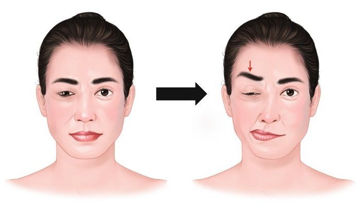 همی فاسیال یا اسپاسم صورت چیست؟
