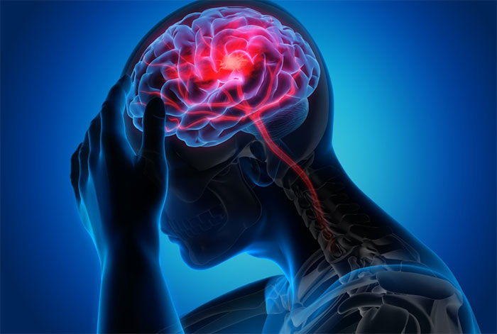 سکته مغزی و ناراحتی در مغز