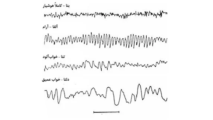 تفسیر نوار مغز غیر نرمال