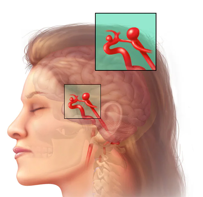 درمان آنوریسم عروق مغزی