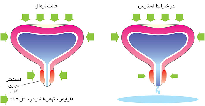 مثانه در حالت نرمال و استرسی