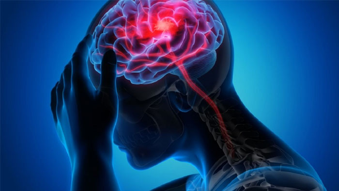 علائم سکته مغزی