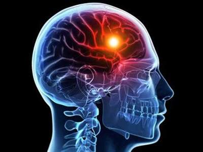 رایج ترین عوارض سکته مغزی
