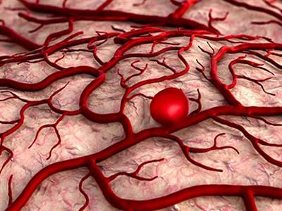 آنوریسم عروق مغزی چیست و چه علتی دارد؟